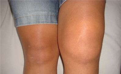 Le cause dell'osteoartrite dell'articolazione del ginocchio