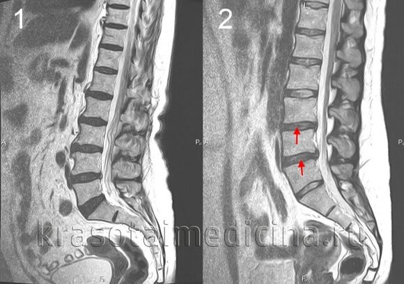 Osteocondrosi della colonna vertebrale
