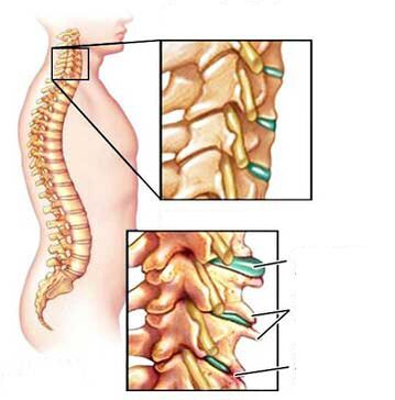 Confronto di una vertebra sana e malata nel collo