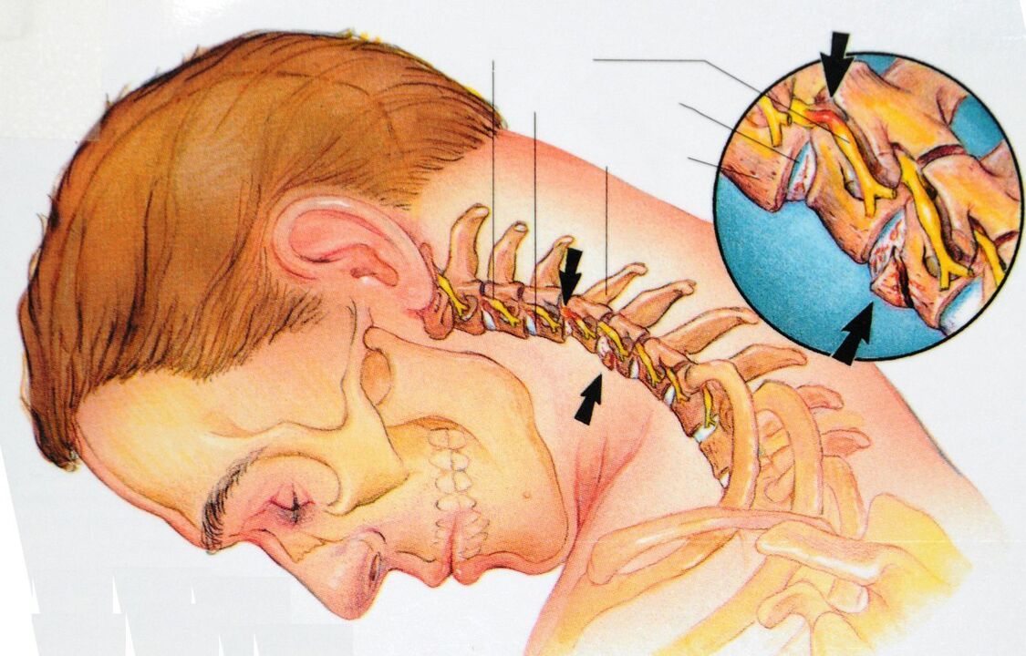 Osteocondrosi della regione di cervice